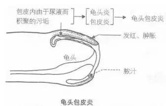 龟头炎的症状是什么？龟头炎的危害是什么？龟头炎怎么治疗？