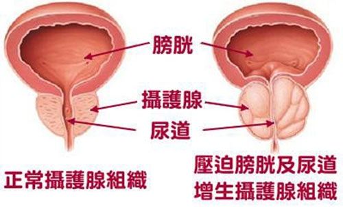 前列腺囊肿的危害？前列腺囊肿的症状？前列腺囊肿怎么预防治疗？