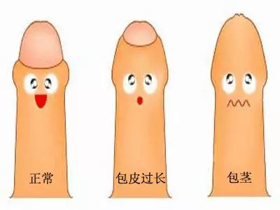 割包皮，根据我亲身经历，这很正常。。