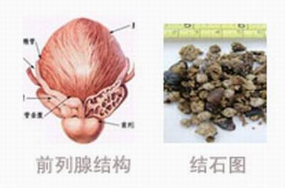 前列腺结石影响,前列腺结石症状,前列腺结石危害,治疗前列腺结石,前列腺结石病因