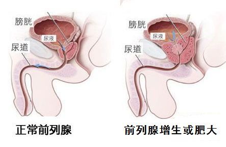前列腺炎症状,前列腺炎用药,前列腺炎治疗,前列腺炎药物